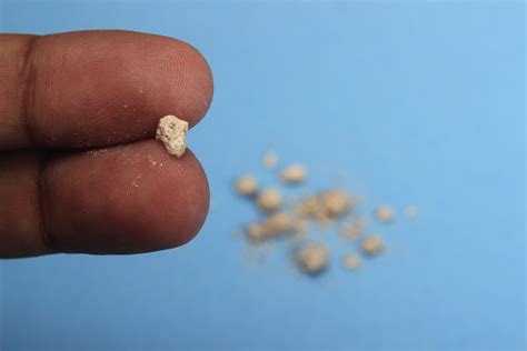 is malt good for kidney stones